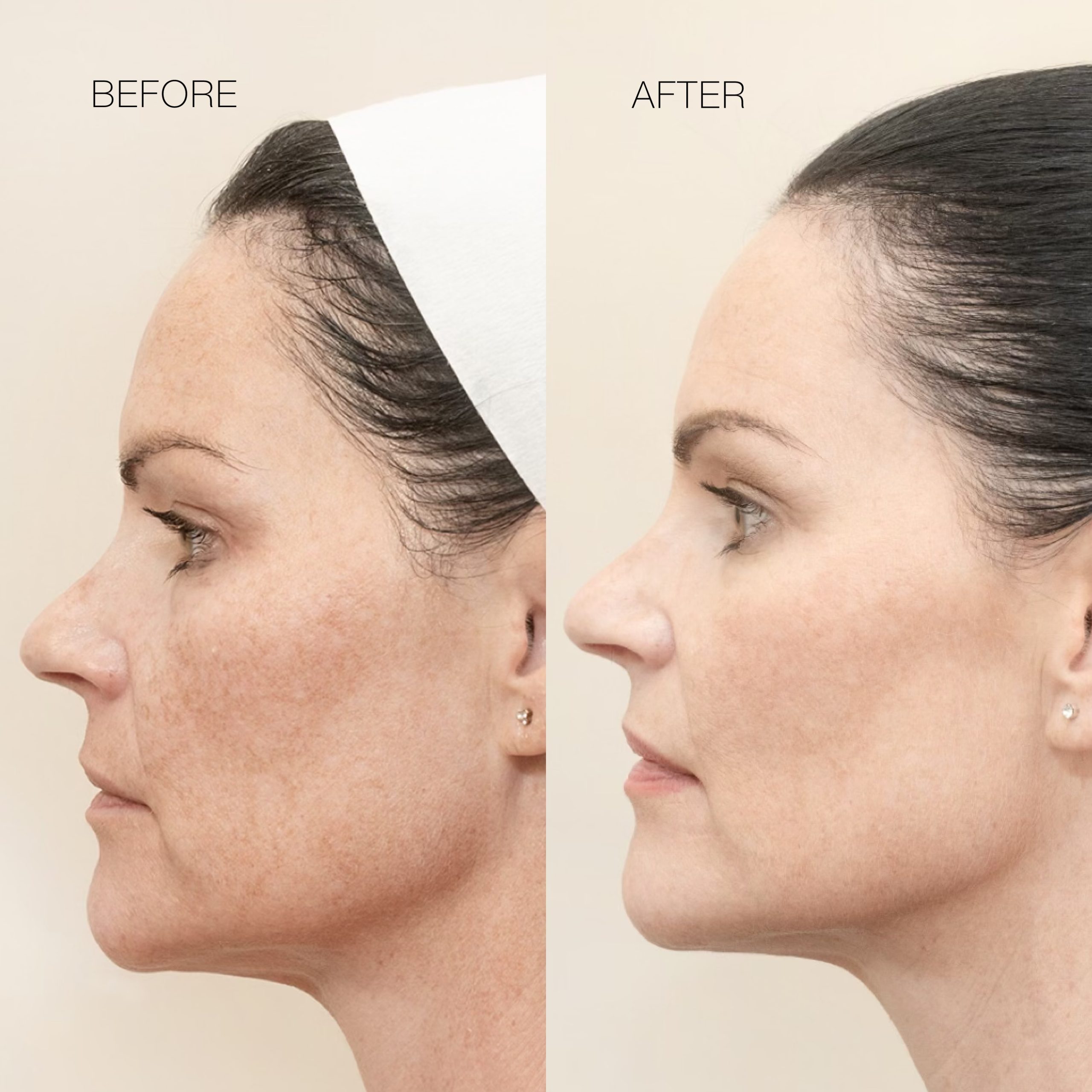 Skin Tightening Technology