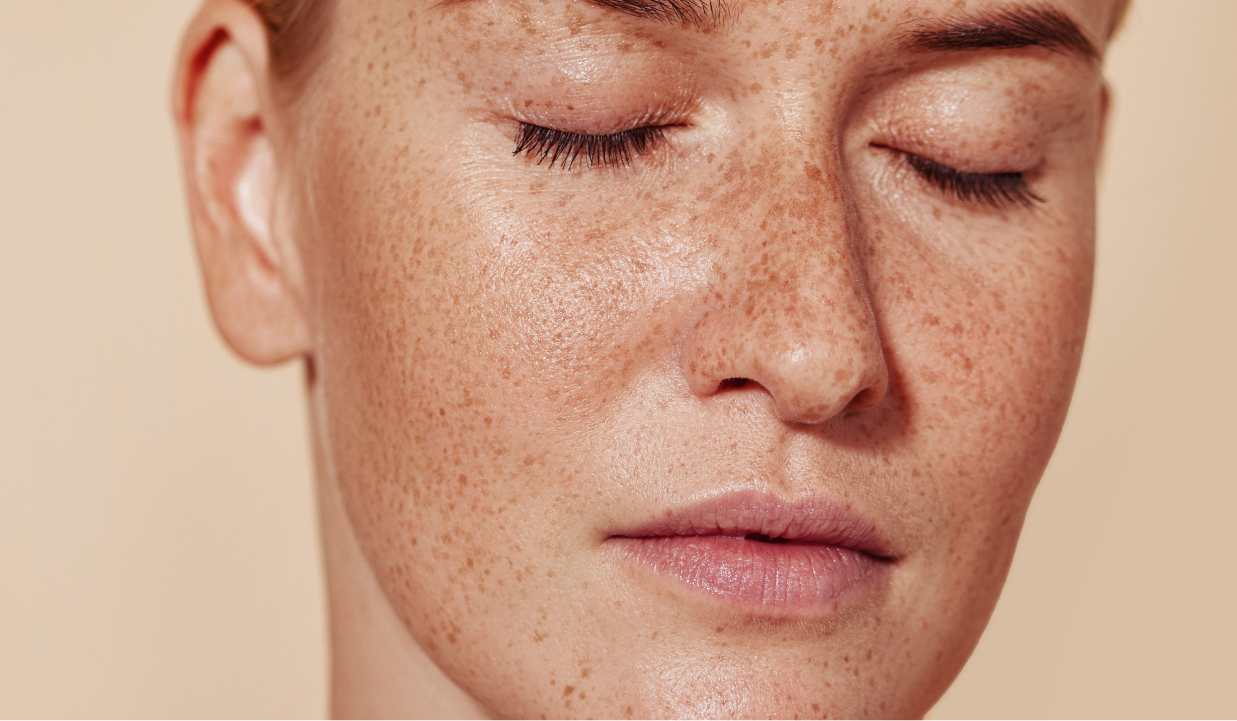 Melasma: Symptoms, Causes and Laser Treatment | BROWZ Dubai